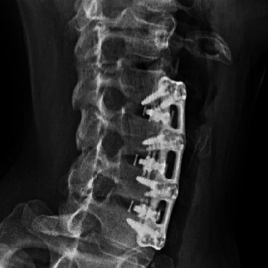 Radiografía lateral de columna cervical con placa anterior colocada